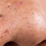 points-noirs-astuces