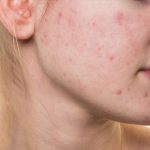 acne-aliments