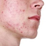 acne-remede